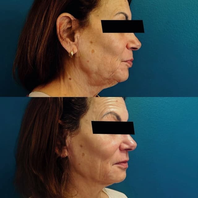 BareFruit Facial Lift & Contour Pkg at BareFruit Body Lab in Alexandria, VA