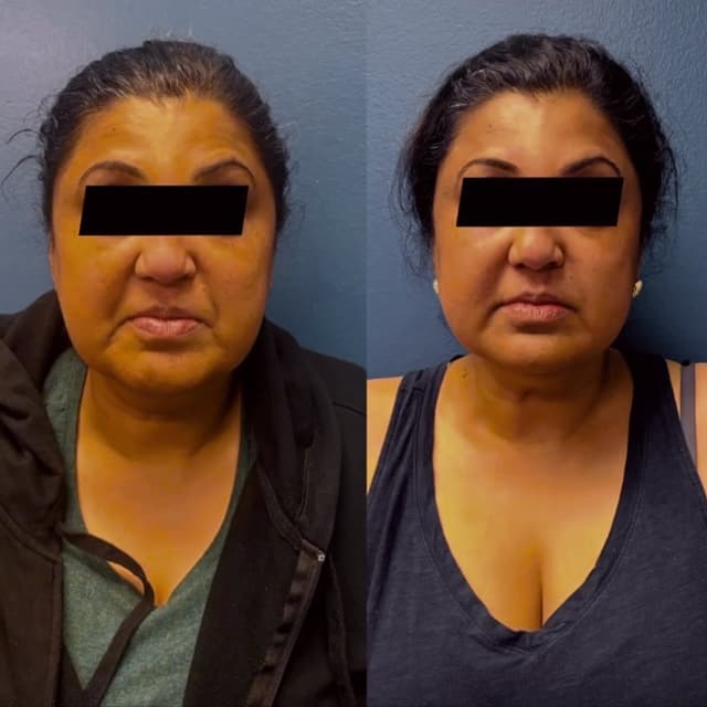 BareFruit Facial Sculpt Experiance at BareFruit Body Lab in Alexandria, VA