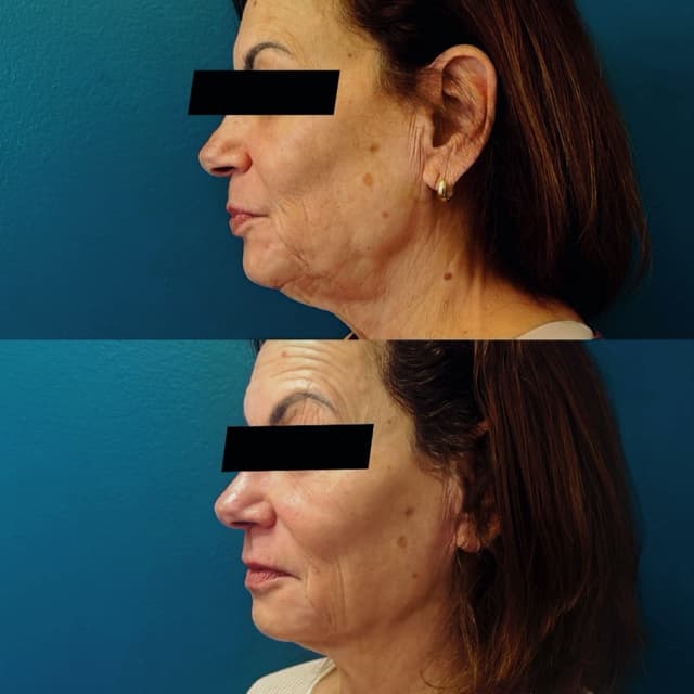 BareFruit Facial Sculpt Starter Pkg at BareFruit Body Lab in Alexandria, VA